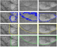 Segmentation of Cortical Spreading Depression Wavefronts Through Local Similarity Metric